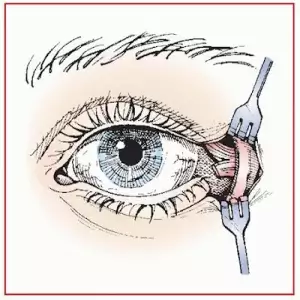 Lateral Cantotomy